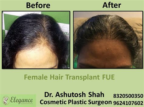 Female Hair Transplant, Hair Regrow Treatment in Vesu