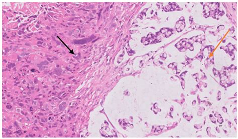Tumor to tumor metastasis of renal cell carcinoma in carcinoma stomach ...