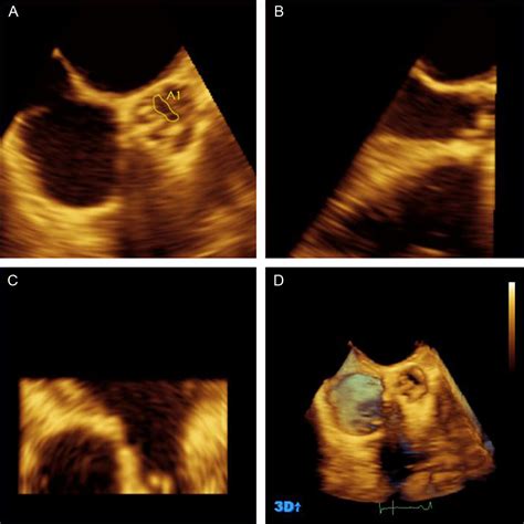 Severe Aortic Valve Stenosis With Low-gradient and Preserved Ejection Fraction: A ...