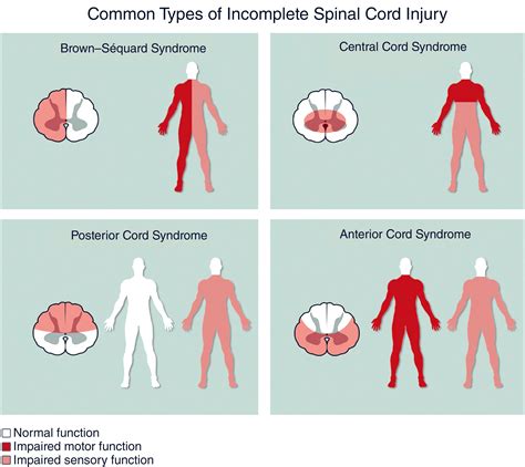 Incomplete Spinal Cord Syndromes