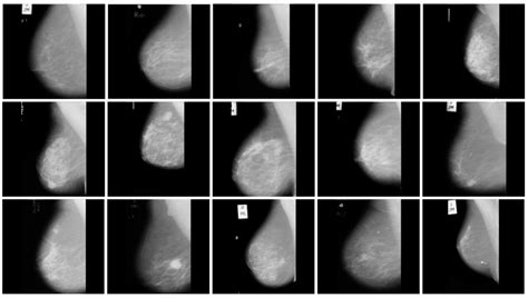 Attention-Based Ensemble Network for Effective Breast Cancer ...