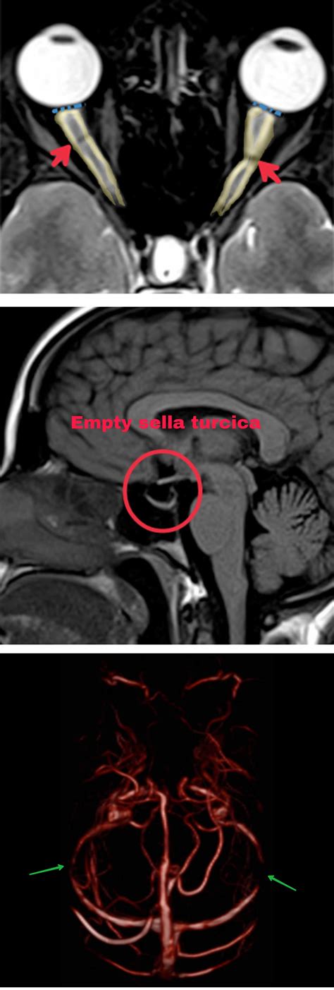 Intracranial hypertension causes, symptoms, diagnosis, treatment ...
