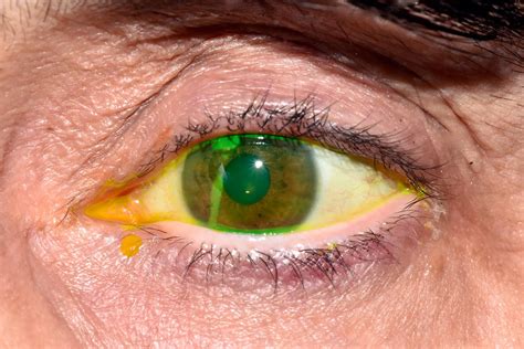 Corneal Abrasion: Healing Time, Treatment, Causes, and More