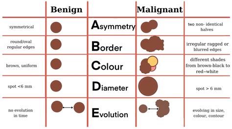 Melanoma Black Spot On Lower Lip at Rita Ellis blog