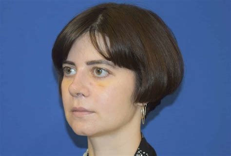 Nose Job Recovery Time: What To Expect After Rhinoplasty