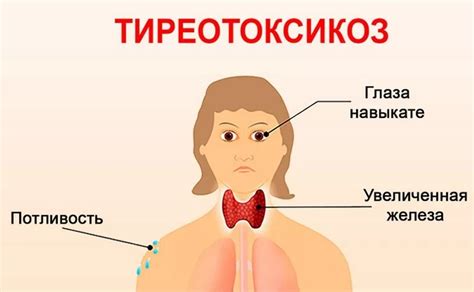 Тиреотоксикоз: симптомы, причины, лечение