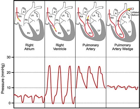 Pulmonary capillary wedge pressure & pulmonary artery wedge pressure