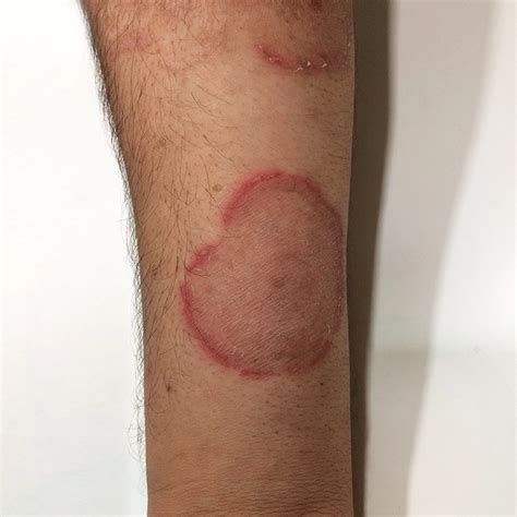 Ringworm Stages Pictures: Know Symptoms, Signs & Treatment Guide