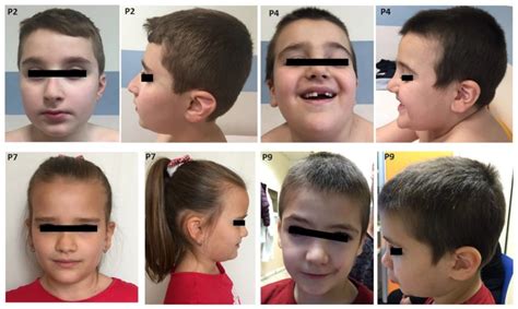 7q11.23 Microduplication Syndrome: Clinical and Neurobehavioral Profiling