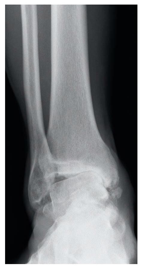 Ankle Osteoarthritis Aetiology