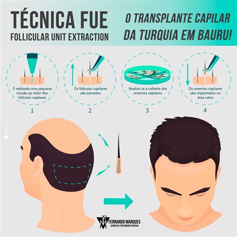 Transplante Capilar - Técnica FUE - Fernando Marques | Clínica de ...