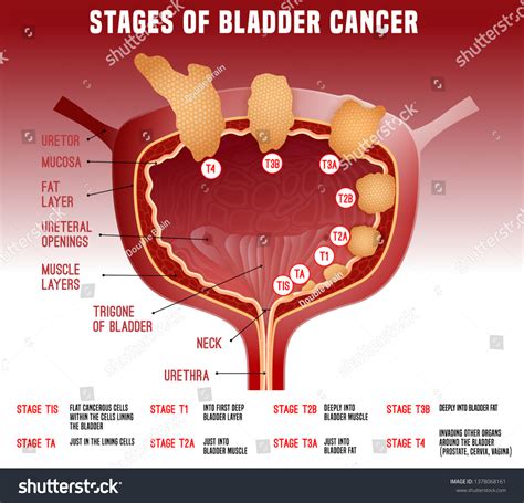 Stages Of Bladder Cancer