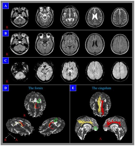Diagnostic Problems in Diffuse Axonal Injury
