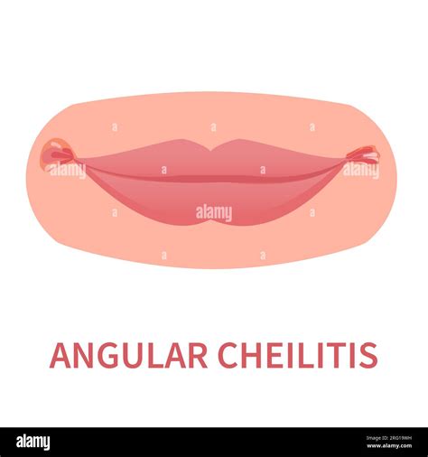 Cracked Lips Corners