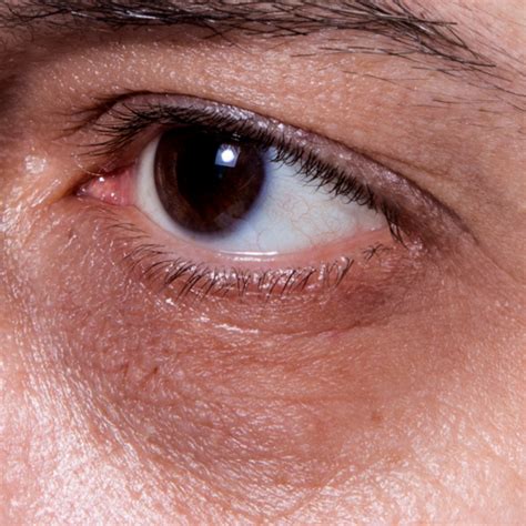 Treatment for Dark circles in delhi With Latest Prices | Best ...