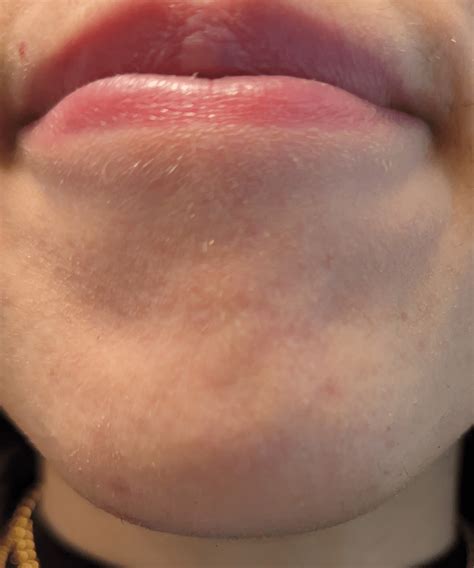 Image result for Chin Botox