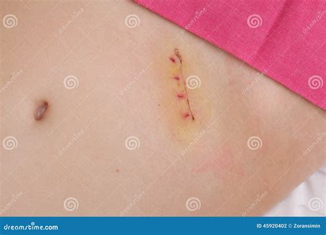 Image result for Appendix Surgery Scar