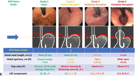 American Society for Gastrointestinal Endoscopy guideline on the diagnosis and management of ...