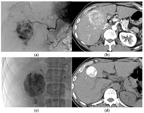 Model Predicting Survival in Intermediate-Stage HCC Patients ...