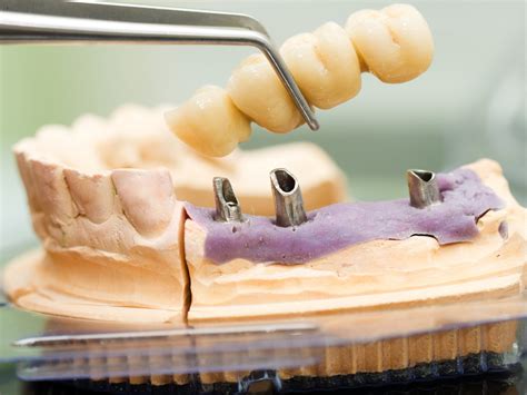 Dental Implant Bridges | Implant-Supported Bridges