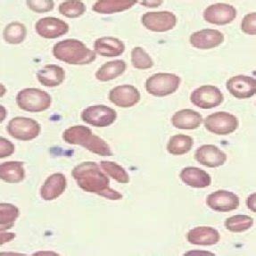 Blood Film Showing Sickle Cell and Target Cells 10X. | Download Scientific Diagram