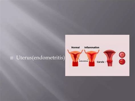 Reproductive System Disorders 的图像结果