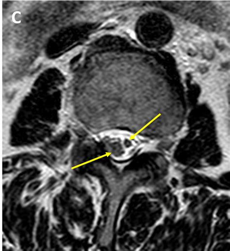 Tethered Cord - MRI Online / Medality