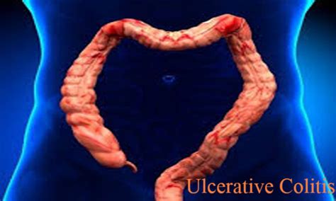 Thiopurine Monotherapy effective in Ulcerative Colitis, Finds study