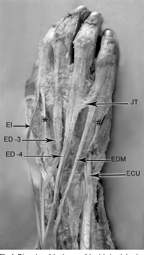 Image result for Extensor Digitorum Communis