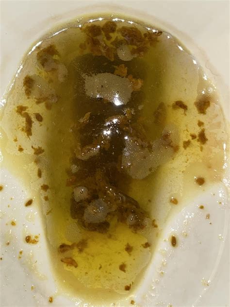 Does this look like exocrine pancreatic insufficiency? (warning stool ...