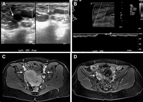 Icd 10 May Thurner Syndrome - Captions Update Trendy