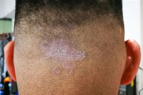 Scalp Ringworm - Tinea Capitis Symptoms, Treatment and Cure – Traya