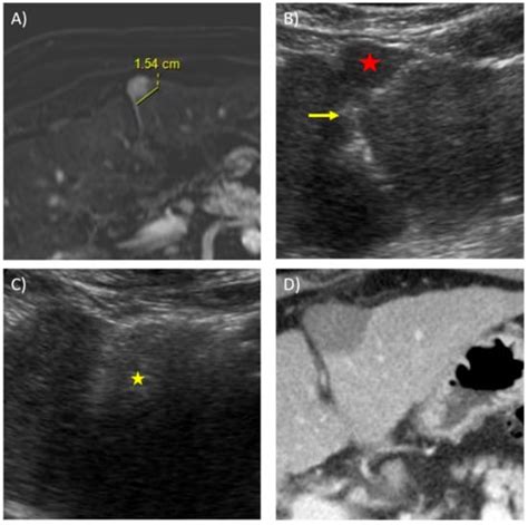 Advanced Techniques in the Percutaneous Ablation of Liver Tumours