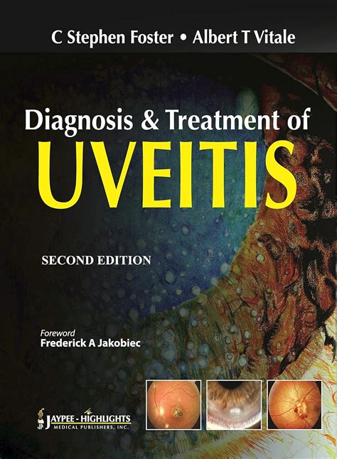 Buy Diagnosis & Treatment of Uveitis Book Online at Low Prices in India ...