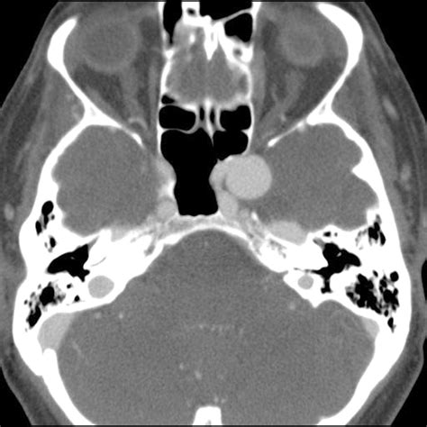 Syndromes of the orbital fissure, cavernous sinus, cerebello- pontine angle, and skull base ...
