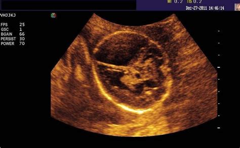十月怀胎，哪几周是胎儿畸形的高发期？孕妈早知早有数 - 百度宝宝知道
