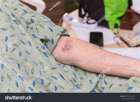Blood Clots Bruises Needles On Elderly Foto de stock 1053378575 ...