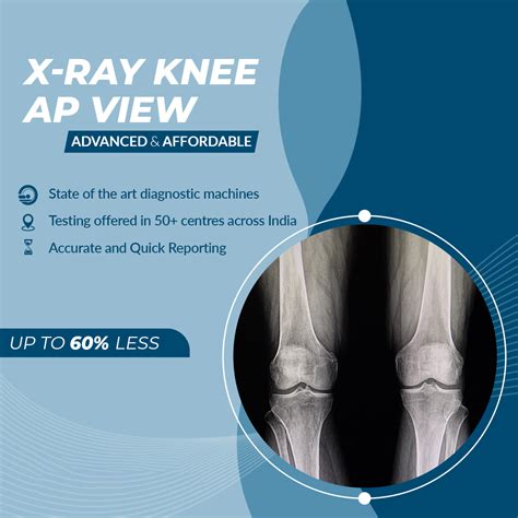 Knee AP View X-ray - Aarthi Scans and Labs