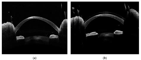 Retrospective Analysis of Sterile Corneal Infiltrates in Patients with ...