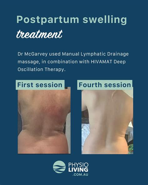 Post-partum swelling — Physio Living Newcastle NSW