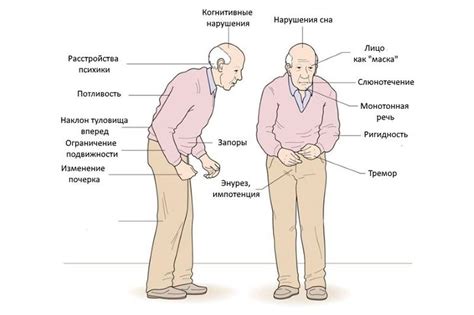 Болезнь Паркинсона: симптомы, лечение, причины, стадии, сколько с ней живут