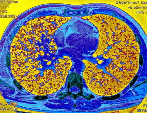How serious is the inflammatory condition known as sarcoidosis?