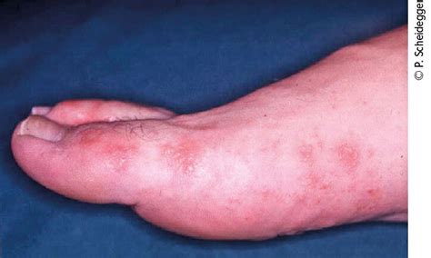 Mycose – ou autre affection? - Universimed - Medizin im Fokus