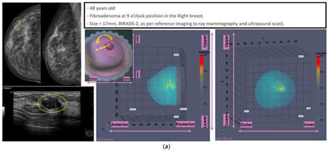 Wavelia Microwave Breast Imaging Phase#2 Clinical Investigation ...