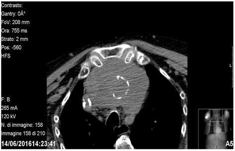Retrosternal Goitre: Anatomical Aspects and Technical Notes