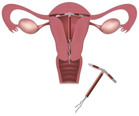 Copper Iud