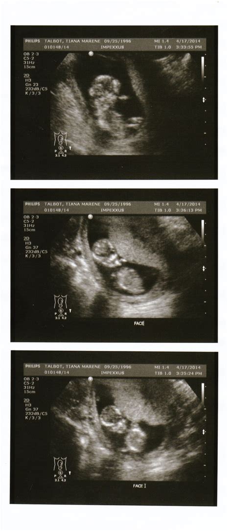 Baby ultrasound | Pregnancy ultrasound, Twins ultrasound, Sonogram pictures