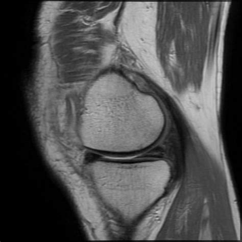 Knee Contusion Mri OrthoDx: Knee Pain In Older Man Clinical Advisor
