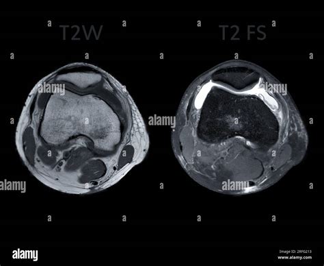Magnetic resonance imaging or MRI of knee joint Axial view T2 and T2 FS for detect tear or ...