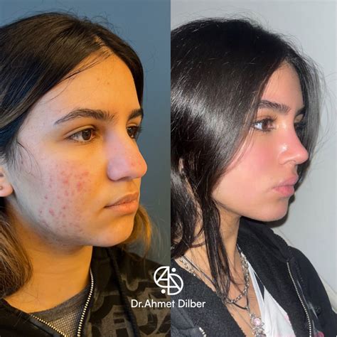 Rhinoplasty nose job – Artofit